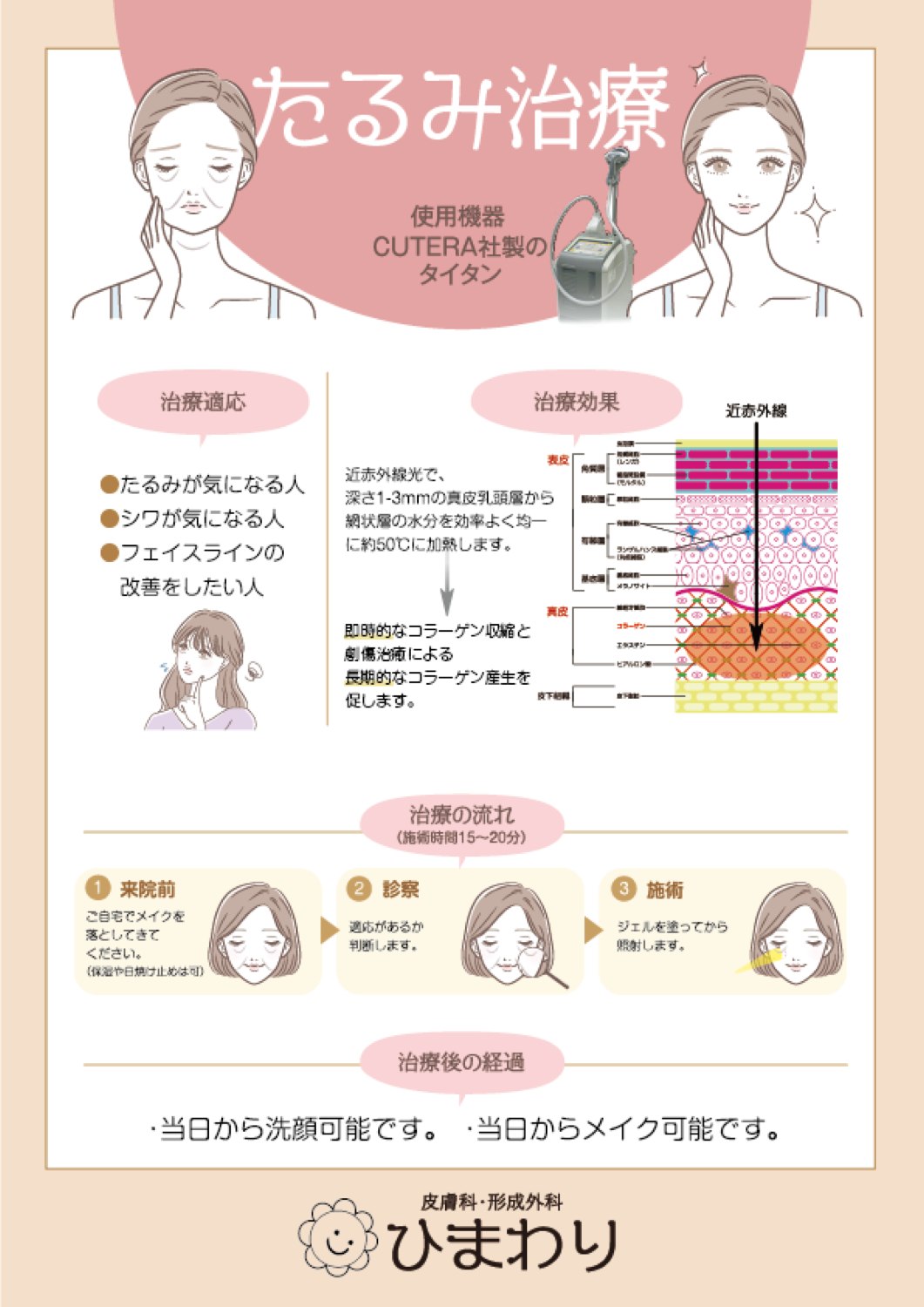 たるみ治療 — 治療内容